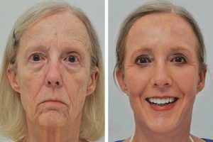 جوانسازی پوست صورت